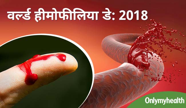 वर्ल्ड हीमोफीलिया डे: अनुवांशिक होता है खतरनाक रोग हीमोफीलिया, जानिये क्या हैं इसके खतरे और लक्षण
